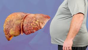 ಫ್ಯಾಟಿ ಲಿವರ್