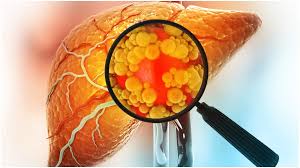 ಫ್ಯಾಟಿ ಲಿವರ್